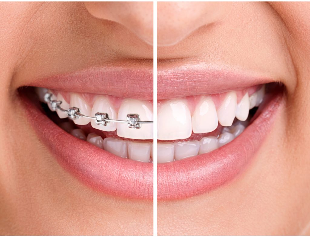 Invisalign Braces: A Perfect Smile Makeover - Clove Dental